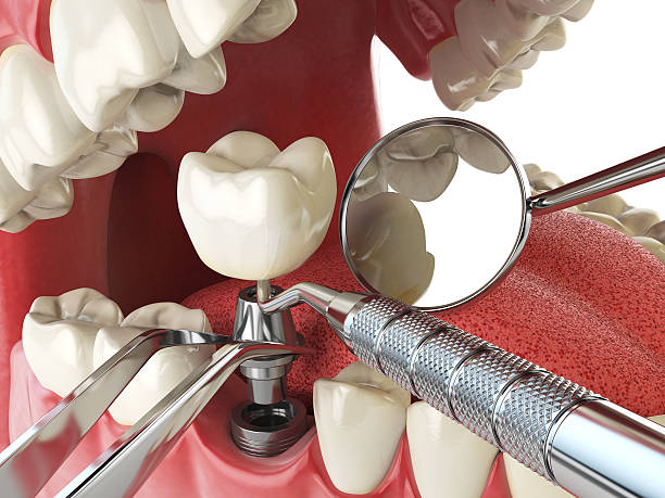 Best Emergency Root Canal Treatment in Tysons, VA